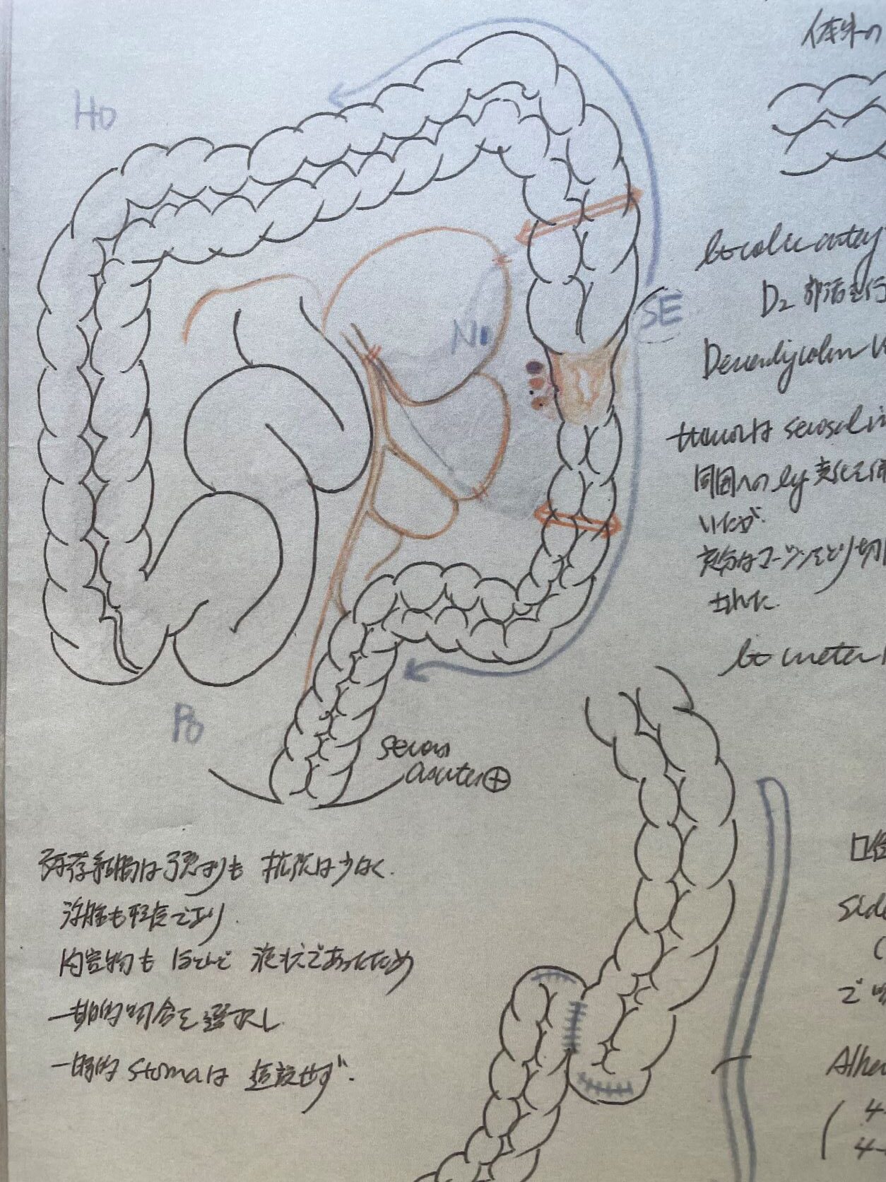 病変部は切除され、残存腸管は吻合された - がんに関するさまざまな情報をご提供していくポータルサイト｜Cancone（キャンコネ）